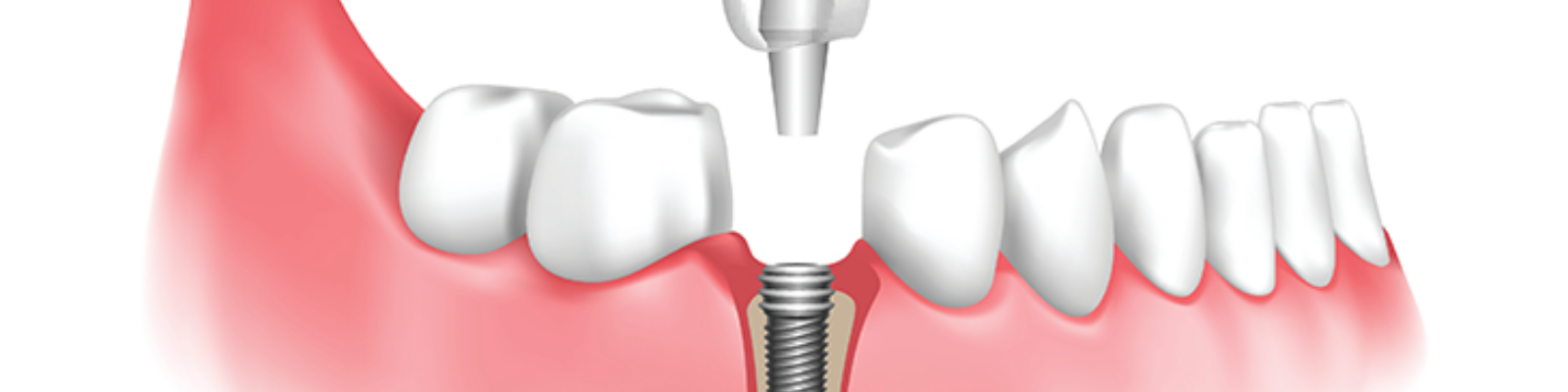 Dental Implant