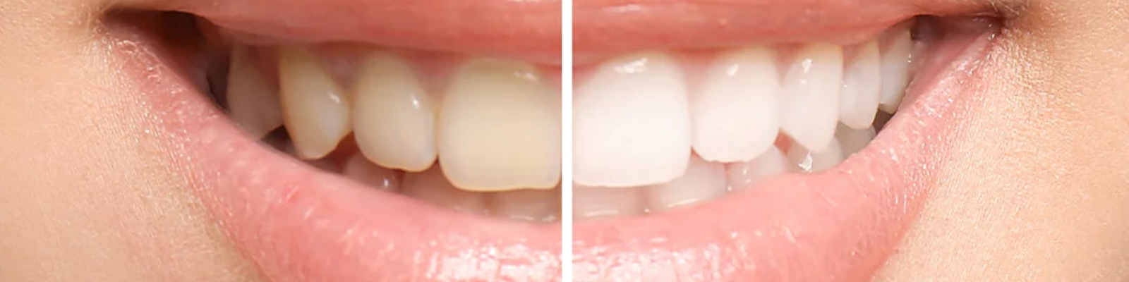 Teeth Whitening & Bleaching